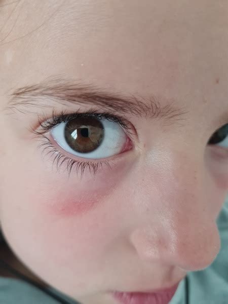 red bags under toddler eyes